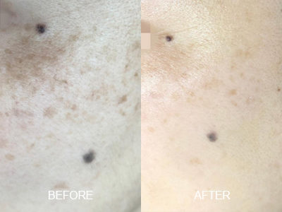 pigment remove