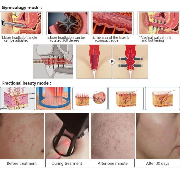 picosure laser